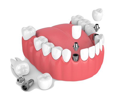 Multiple Teeth Dental Implants in Daly City