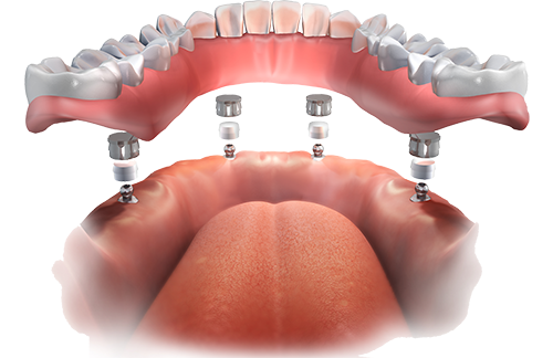Implant Overdentures Daly City